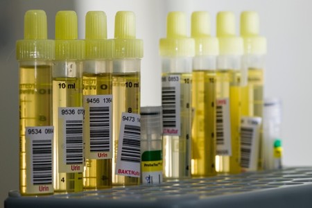 Urine test detects early-stage pancreatic cancer